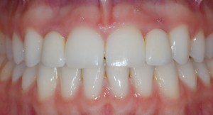 Dental Implant After Image