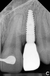 Dental Implant X-Ray with tooth