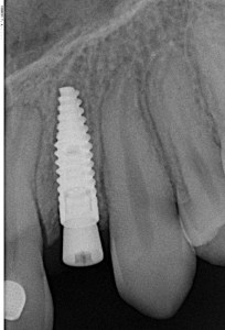 Dental Implant X-Ray
