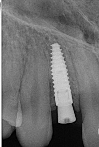 Dental Implant X-Ray