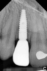 Dental Implant X-Ray with tooth