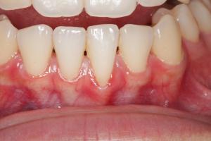 Connective Tissue Grafting patient
