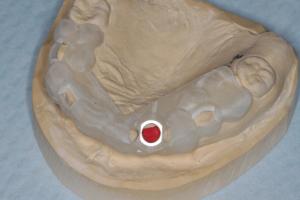 Dental Implants Molding
