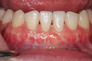 Connective Tissue Grafting patient