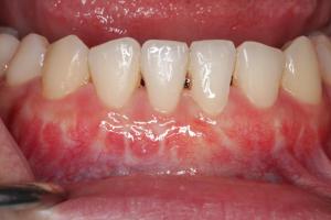 Connective Tissue Grafting patient